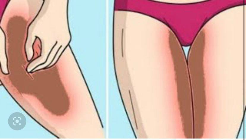 Темная кожа и папилломы в промежности: причины и лечение