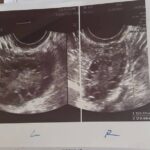 Миома матки 3 см: операция или сохранение?