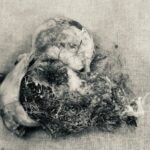 Удаление гигантской дермоидной кисты: случай из практики